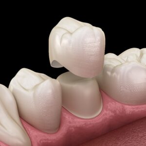 Prothetischer Zahnersatz in Hamburg: Präzise Anpassung von Zahnkronen auf Prämolaren für medizinische Genauigkeit