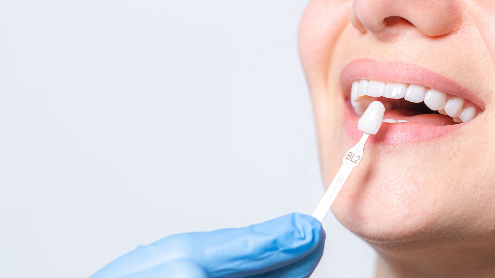 Frau bei der Zahnbehandlung mit Veneers in Hamburg