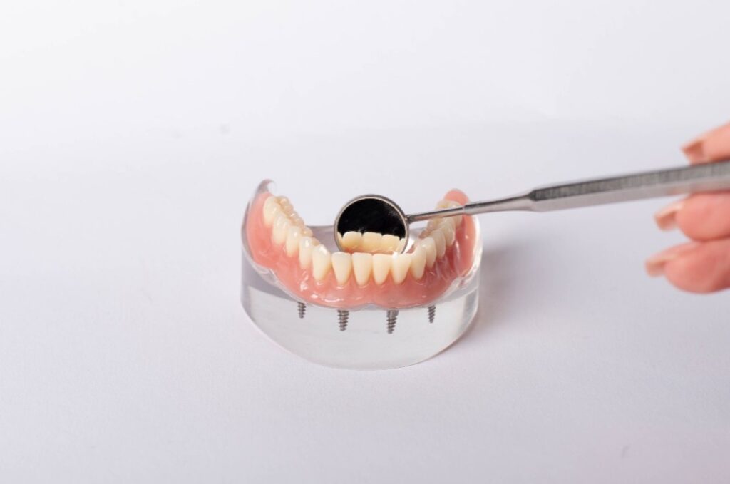 Unterkieferprothese im All-on-4-System auf Implantaten